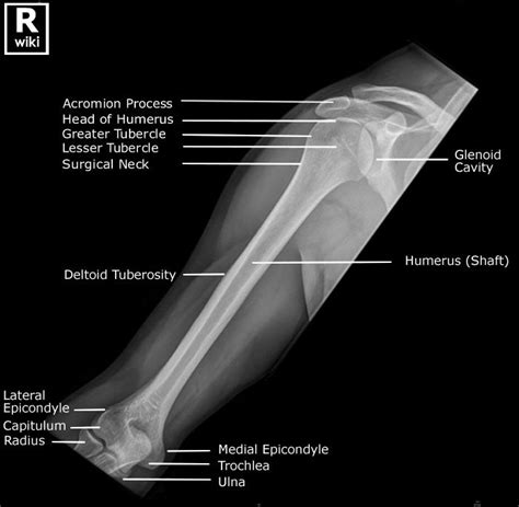 Radiographic Anatomy Of The Humerus Medical Radiography Radiology