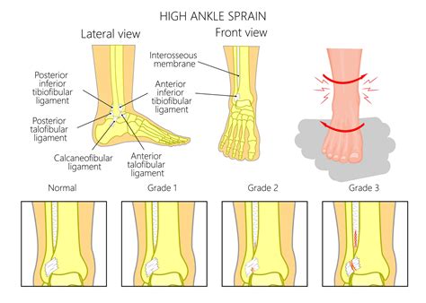 High Ankle Sprain Versus Low Ankle Sprain Beacon Orthopaedics My Xxx Hot Girl