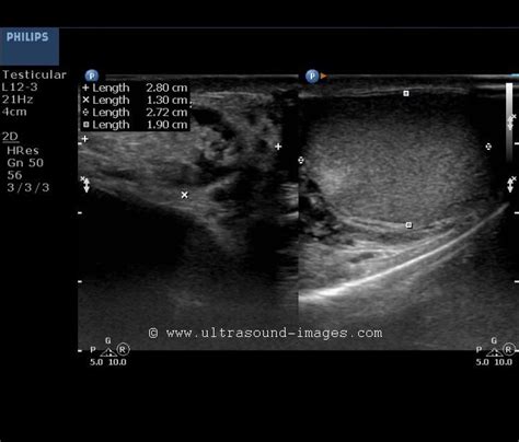 Inguinal Scrotal Hernia Ultrasound