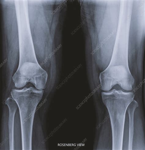 Healthy Knees X Ray Stock Image F0375537 Science Photo Library
