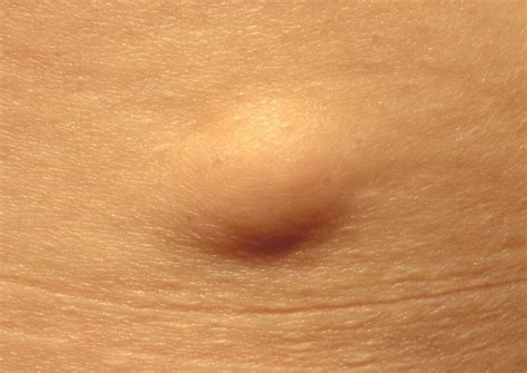 Hard Lump Under The Skin Causes And Pictures
