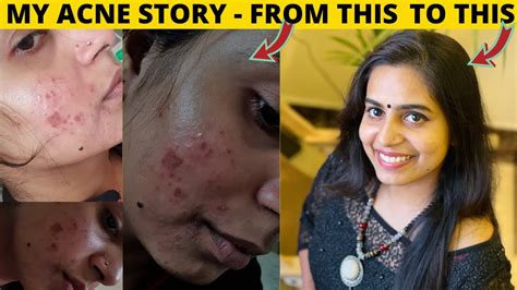 My Acne Story How I Cleared My Acne Youtube
