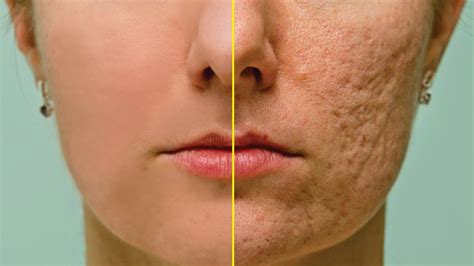 How To Clean Face From Acne In Photoshop Remove Acne Photoshop