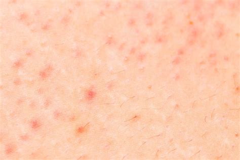 Skin Conditions That Look Like Acne Readers Digest