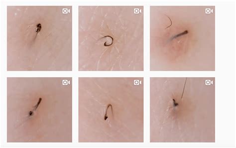 We attempt to treat and prevent them, fumbling through adolescence with diy google firstly, arezoo explains exactly what they are: This Instagram Account Is The Dr. Pimple Popper For ...