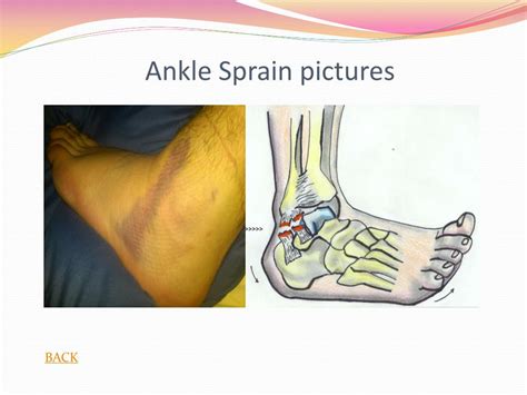 Ppt Ankle Injuries Powerpoint Presentation Free Download Id3630042