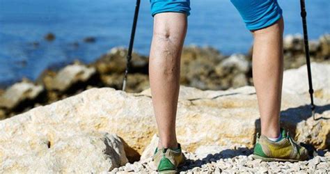 Varicose Vein Treatment San Diego Everything You Need To Know