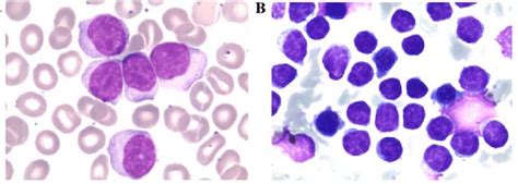 Case 1 A Peripheral Blood Smear Revealed Small Mature Lymphocytes