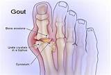 Images of Medical Condition Gout
