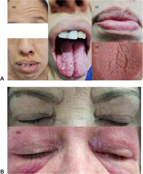 Chronic Urticaria And Angioedema Masqueraders And Misdiagnoses The