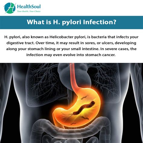 H Pylori Infection Symptoms And Treatment Gastroenterology HealthSoul