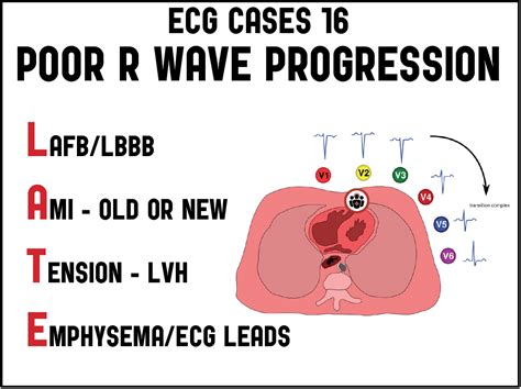 Ecg Cases 16 Poor R Wave Progression Late Mnemonic Ecg Cases