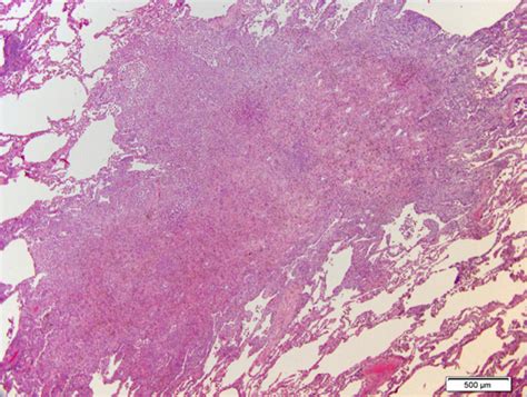 Pulmonary Langerhans Cell Histiocytosis Chest