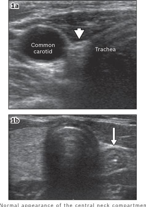 Pdf Post Thyroidectomy Neck Ultrasonography In Patients With Thyroid