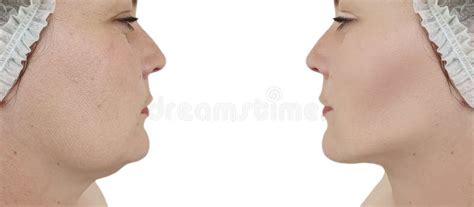 Woman Double Chin Lift Before And After Procedures Stock Photo Image