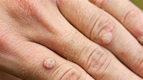 A Wart Can Affect Your Professional Life So Have Yours Removed