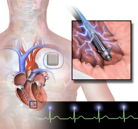 Cardiac Defibrillator Baltimore Cardiologists Woodholme