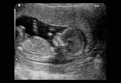 12 Weeks Pregnant Ultrasound Image Process And Accuracy