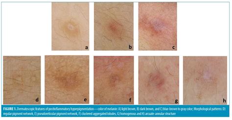 A Comparative Study Of Dermatoscopic Features Of Acne Related