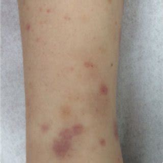 Characteristic Rash In The Lower Extremities In A Patient With Download Scientific Diagram