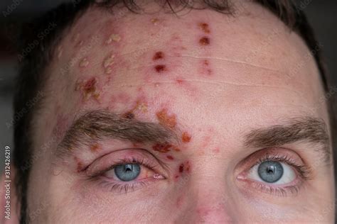 Man With Herpes Zoster Shingles On The Face Close Up Inflamed