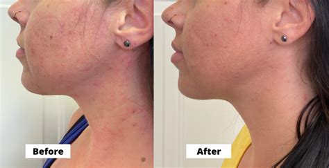 acne cosmetic acupuncture before and after photos seneca falls