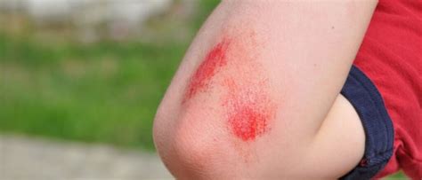 Cuts Scrapes And Blisters Coastal Med Urgent Care