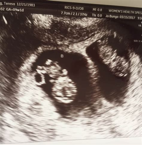 We did not find results for: 12 Weeks Pregnant with Twins: Tips, Advice & How to Prep ...