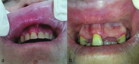 Lichenoid Lesions Of The Upper Lip A Retrospective Study Of 24 Cases