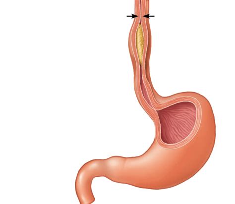 Free Esophagus Cliparts Download Free Esophagus Cliparts Png Images