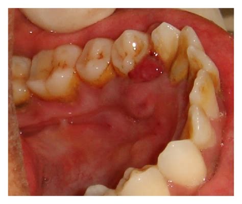 Exophytic And Hemorrhagic Lesion In The Lower Canine Premolar Region