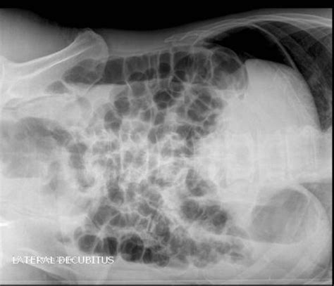 Lateral Decubitus View Of An Abdominal X Ray Showing Free Intra