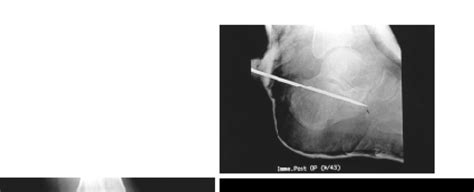 Fig A. Preoperative X-ray shows tongue type intraarticular ...