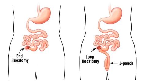 Loop Ileostomy Closure At An Ambulatory Surgery Facility A Safe And