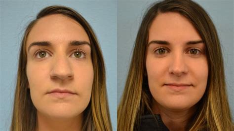 Nose Surgery Before And After Photos Patient 160 San Francisco Ca