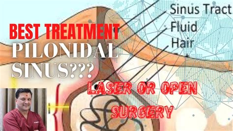 Can Pilonidal Sinus Be Cured Without Surgery Dr Sameer Gupta Laser