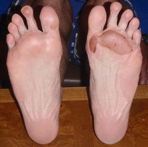 Top 98 Wallpaper Pictures Of Blisters On Feet Superb