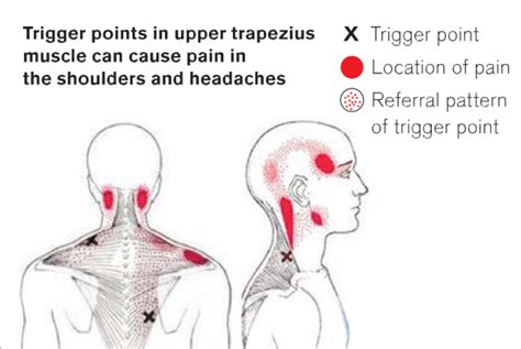Aching Neck And Shoulders Are They Muscle Knots