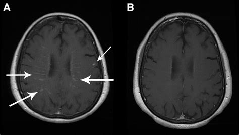 Cerebrovascular Events In Lyme Neuroborreliosis Journal Of Stroke And