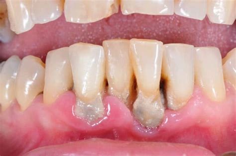 Gums Of Mouth Cancer X Ray