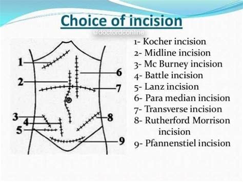 Some Common Surgical Incisions And Their