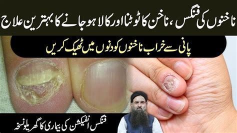 Fungal Infection In Private Parts Fungal Infection Treatment Tadri