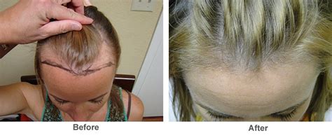 Common Female Hairline And Hair Loss Treatments Hair Transplant