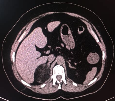Adrenal Myelolipoma Radiology Imaging Radiology Adrenals
