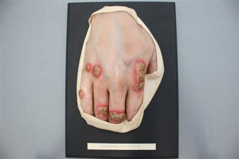 Tuberculosis cutis verrucosa tuberculosis cutis verrucosa (icd10: Moulage, Tuberculosis verrucosa cutis (Hand) [G. S ...