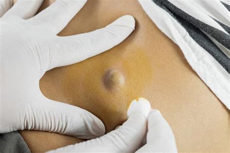 Underarm Cyst Causes Pictures Painful Sebaceous Symptoms