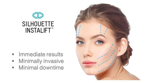 What To Expect Before During And After Silhouette Instalifttm Face