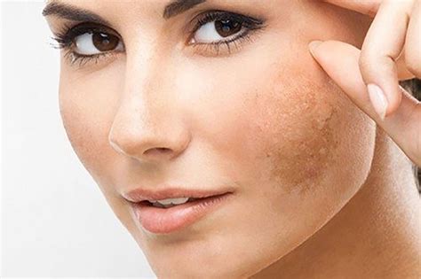 What Is Skin Darkening Is It A Disease Or Not