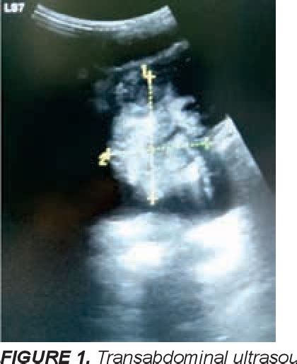 Figure 1 From Role Of Cystitis Glandularis And Intestinal Metaplasia In