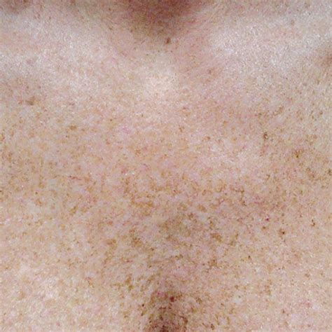 Brown And Age Spot Removal Kelowna Before Photo Cerulean Medical